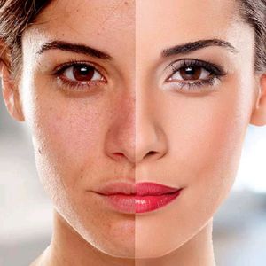 Acne Wrinkles Solution (150 Mein 1 Manth Use Karo)