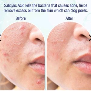 2% Salicylic Acid Serum For Acne Pimple